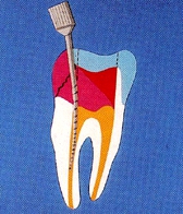歯の根の治療1